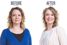 Pam Type 2 before and after photo